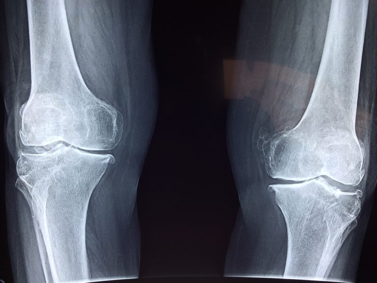 Lesiones de cartílago de rodilla tratamiento
