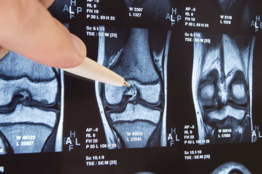 Especialista en rodilla en Monterrey