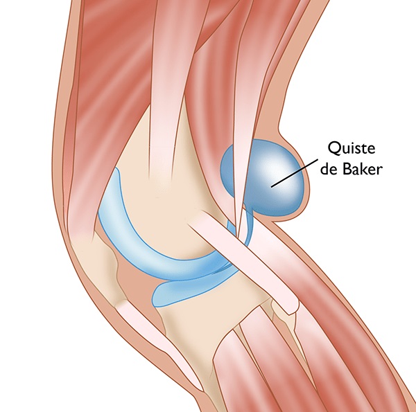 desgaste de rodilla