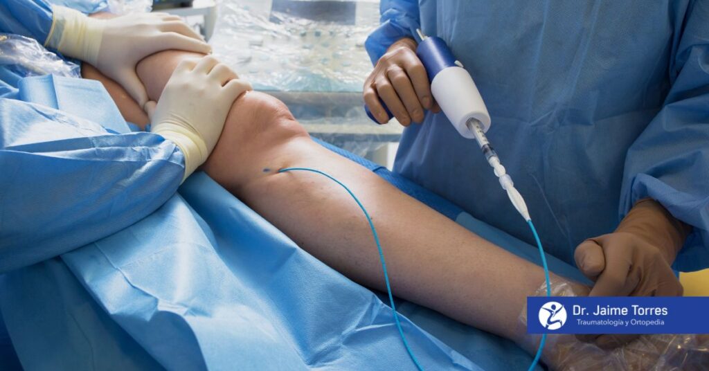 fractura-de-tibia-y-perone-operacion